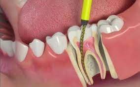 Root Canal Treatment